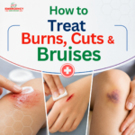 How to Treat Burns, Cuts & Bruises at Home the Right Way — A Complete First Aid Guide